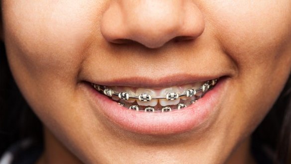 Teeth Before Orthodontics